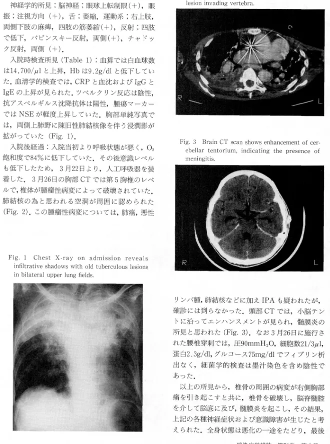 Fig.  2  Chest  CT  scan  at  Th5  level  shows  mass lesion  invading  vertebra.
