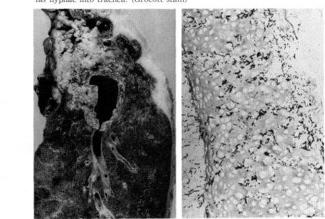 Fig.  4  (left)  Coagulation  necrosis  due  to  IPA  and  old  tuberculous  cavities  with thickened  pleura  of  the  right  upper  lung