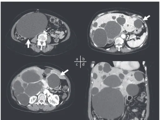 Fig. 1　Abdominal enhanced CT. Multiple tumors with no contrast effect can be observed throughout the liver (white arrow  a: S6, b: S2, c: S3)