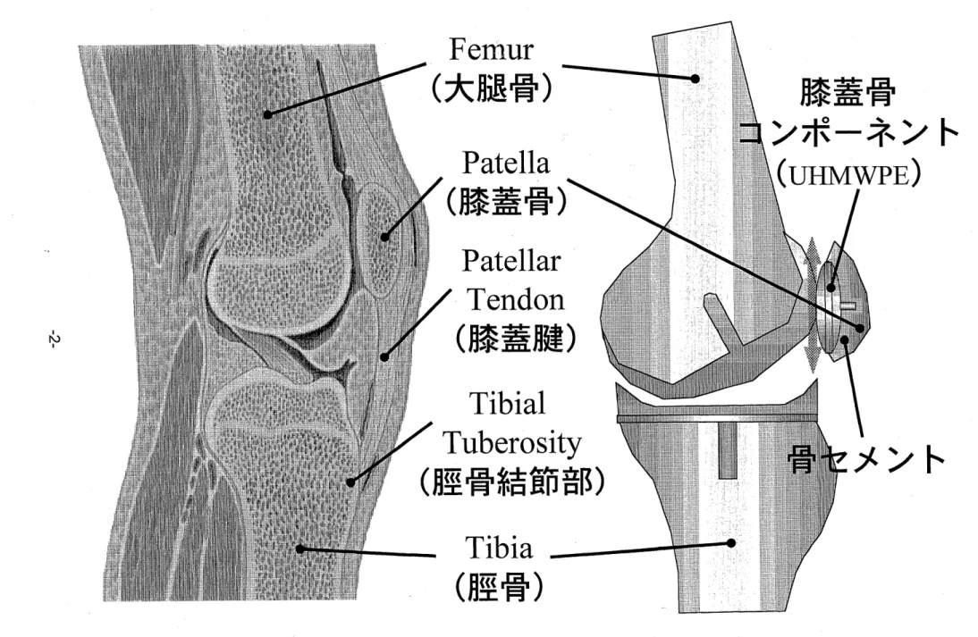 図 1. 1 膝関節および人工膝関節置換術後の膝関節概略図