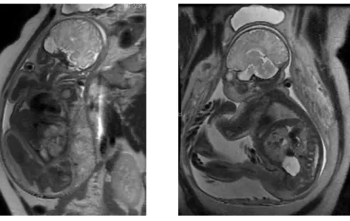 Fig. 4  T2 SSFSE Fig. 5  T2 SSFSE