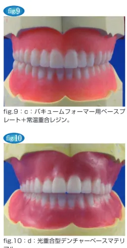 fig. 7 fig.7：a：ベースプレート用常温重合レジン。 fig. 8 fig.8：b：流し込みレジン。 fig.9：c：バキュームフォーマー用ベースプレート＋常温重合レジン。fig.10fig.10：d：光重合型デンチャーベースマテリアル。fig.11 fig.11：即時義歯製作にかかるコストの比較。方法で上下顎各一床の全部床義歯を製作し（fig.7〜10），必要なコストを計算した。方法は，歯肉部分に用いた材料による分類として，「a：ベースプレート用常温重合レジン」，「b：流し込みレジン」，「c：バ