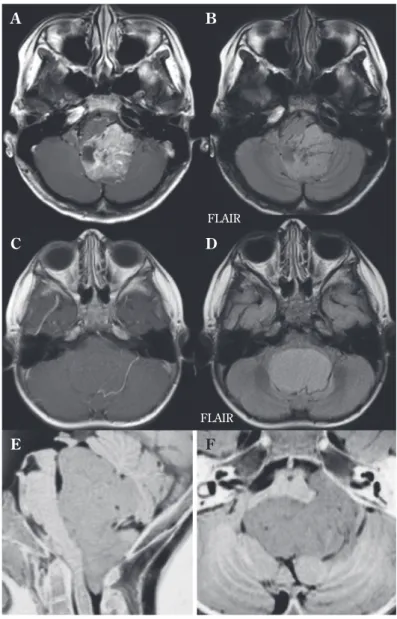 Fig. 2 Fourth ventricle ependymomas