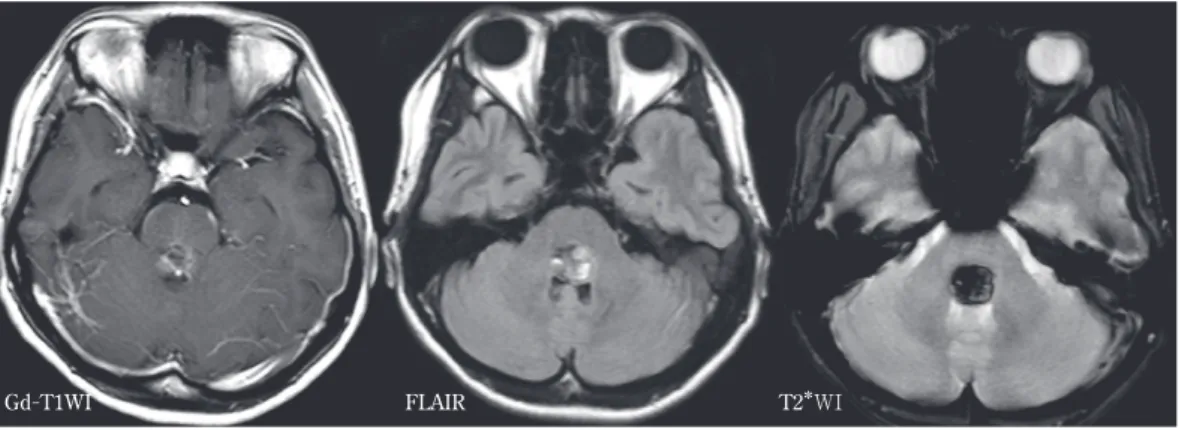Fig. 5 Dorsal pontine cavernous malformation