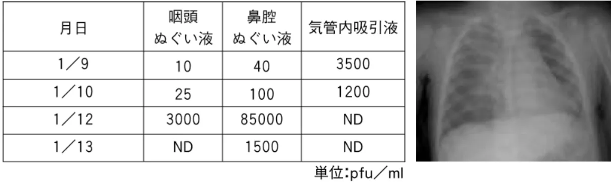 図 5 インフルエンザ肺炎患児（11 ヶ月）のウイルス排泄と胸部 L 線像 呼吸障害のため挿管された A 香港型の乳児例．発病初期の咽頭ぬぐい液と鼻腔ぬぐい液のウイルス感染価は低いが，気管内吸 引液の感染価は高かった． 図 6 アマンタジンを投与した小児 A 型インフルエンザ症例のウイルス分離の経過 2）症例 年齢 亜型 合併症 耐性変異株出現 - 2- 1投与開始日 12345678 9 日後 10AH1＋ +++− − 21AH3熱性痙攣 ＮＴ +− − 3米 1AH1熱性痙攣 ー +− − +++41