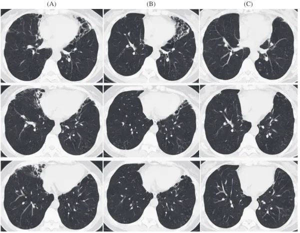 Table 3 Surgical characteristicsFig. 1 Chest CT scans of Case 10