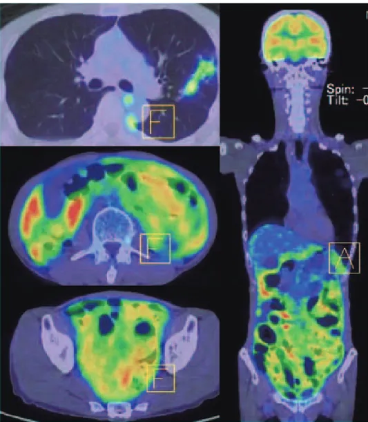 Fig. 4 PET-CT: accumulation of FDG was seen in left upper lobe and entire peritoneal cavity.
