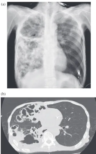 Fig. 1 (a) Chest X-ray shows a large cavity in the right upper  lung  ﬁ eld,  and  inﬁ ltrative  opacities  in  the  right  lower  and  in  the left upper lung ﬁ elds.  (b) Chest CT shows abnormal ﬂ uid  collections in multiple cavities and inﬁ ltrative op