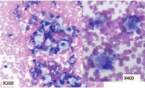 Fig. 2 Bone marrow smear shows increased macrophages and phagocytosis  of erythrocytes  and  platelets.
