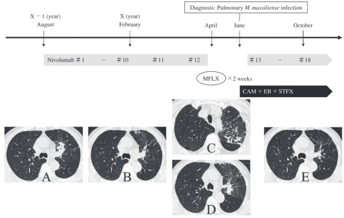 Fig. 1 Changes over time in contents of treatment and pulmonary lesion on computed tomography (CT).  (A) Chest CT  showed mass lesion around left upper bronchus prior to administration of nivolumab.  (B) After the patient received 10  cycles  of  nivolumab