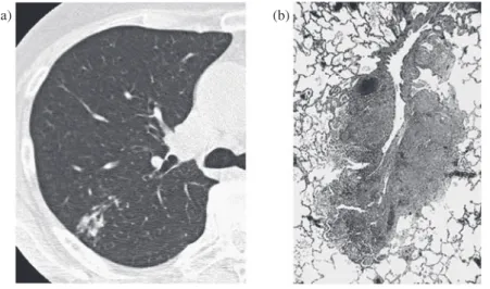 Fig. 4 Nodular opacity is the most common radiologic pattern of NTM disease in CT imaging,  corresponding to the granuloma formation in pathology.