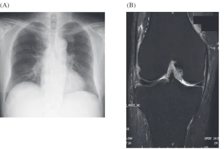 Fig. 3 Image ﬁ ndings after anti-tuberculosis treatment. (A) Chest X-ray examination  exhibited  the  disappearance  of  the  left  pleural  effusion.  (B)  Knee  MRI  examination  revealed enhanced joint synovial thickening.(A) (B) 考   察  肺外結核は，肺および気管・気管支