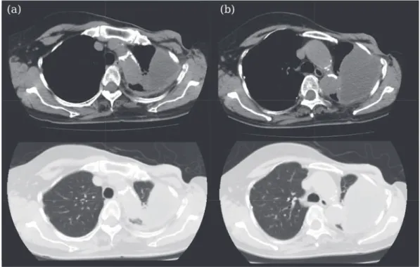 Fig. 2 (a)  Chest  CT  scan  at  the  ﬁ rst  visit  revealed  empyema  in  the  left  upper  ﬁ eld.  There  were  no  inﬁ ltrative  or  nodular  shadows  in  both  lung  ﬁ elds.  (b)  After  6  months,  remarkable  enlargement  of  the  empyema was shown. 