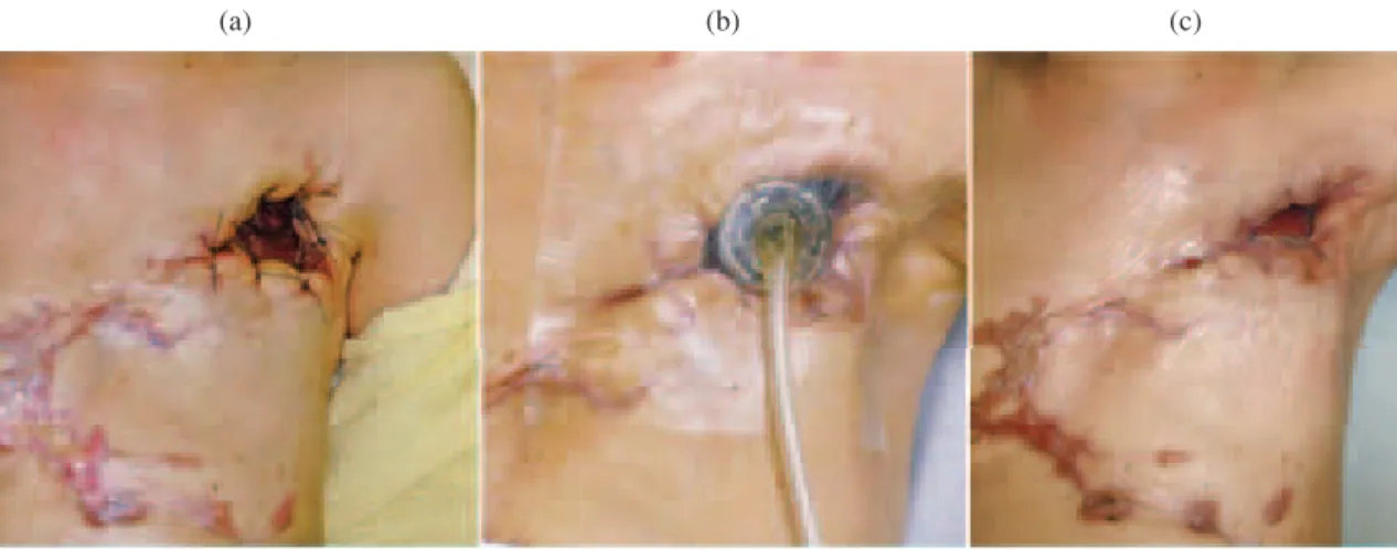 Fig. 3 Photographs of the wound. (a) The wound just after surgery. (b) Negative pressure wound  therapy was induced after surgery. (c) The wound had improved on post operation month 4.(a)(b)(c) たが，近年報告例が散見されるようになった 2) 。一方， 慢性膿胸に関してはさらに稀な病態であり，調べえたか ぎりでは 5 