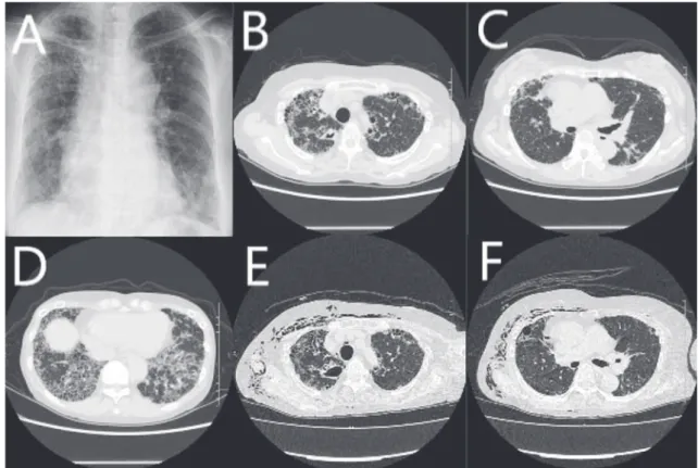 Fig. 1 A: Chest X-ray before chemotherapy. B̲D: HRCT before chemotherapy. E, F: HRCT on 2nd admission.  Chest X-ray before administration of anti-mycobacterial chemotherapy exhibits reticular shadows in the both lungs (A).  Chest CT scans before administra