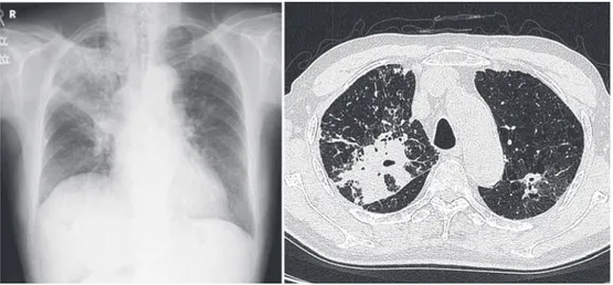Fig. 1 Chest radiograph and Chest CT Chest radiograph showed consolidation in the both upper lung ﬁ eld. Chest CT scan showed cavity,  consolidation, nodules in the both lung ﬁ eld.  Table Laboratory ﬁ ndings on admission and D151 Hematology        [admiss