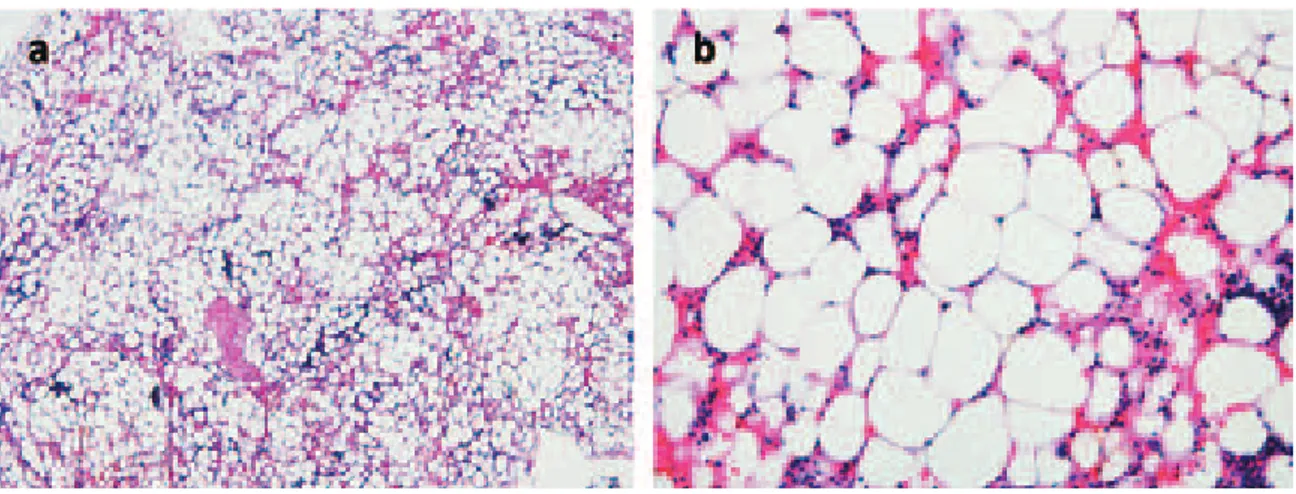 Fig. 2 Bone marrow aspiration Original magniﬁ cation of (a) ×40, and (b) ×200, H＆E staining. It shows low cellularity affecting all  hematopoietic lineages