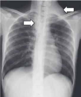 Fig. 1 Chest  X-ray  on  admission  showed  swelling  of  left  cervical tissue and upper right mediastinum (white arrows)