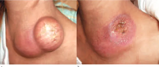 Fig. 4 Contrast-enhanced  CT  revealed  enlargement  of  mediastinal  lymph  nodes  and  trachea  compression.  White  arrow indicates the target lymph node of puncturing