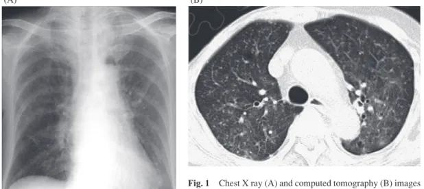 Fig. 1 Chest X ray (A) and computed tomography (B) images   just before the starting anti-tuberculosis drugs. Diffuse micro-nodules were shown in bilateral lung fields.