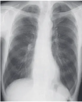 Fig. 1 Chest X-ray showed nodules in the right  middle peripheral lung ﬁ eld.