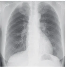 Fig. 3 Chest X-ray showed patchy shadow in the  left lower lung ﬁ eld. Fig. 4 Chest CT showed bronchiectasis with nodules and inﬁ ltration in the left lower  lobe (A).  Chest CT showed new  inﬁ ltration in the right middle lobe after two and a half years (