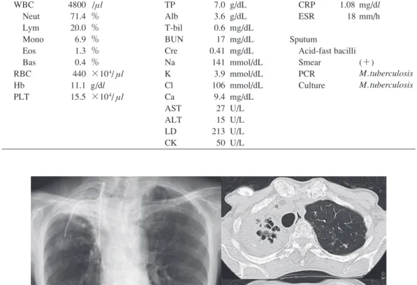 Fig. 1 Chest X ray and CT scan on admission. Consolidation with cavity can be seen, especially  in right upper lobe. A CV port is planted on her body.  Table Laboratory ﬁ ndingsHematology WBC   Neut   Lym   Mono   Eos   Bas RBC  Hb  PLT 480071.4 20.0 6.9 1