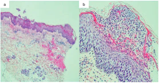 Fig. 4 Histological ﬁ ndings of skin (hematoxylin and eosin stain  a :×40, b :×100) : There are numerous  neutrophils in the epidermis and subcorneal pustules. Kogoj s spongiform pustule can be seen.ab 軽度角化性紅斑はみられるもののワセリン外用のみで対 処できていた程度であった。また，解熱し膿疱が消退し た後