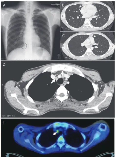 Fig. 2 Radiologic ﬁ ndings of the patient s pulmonary lesions. 
