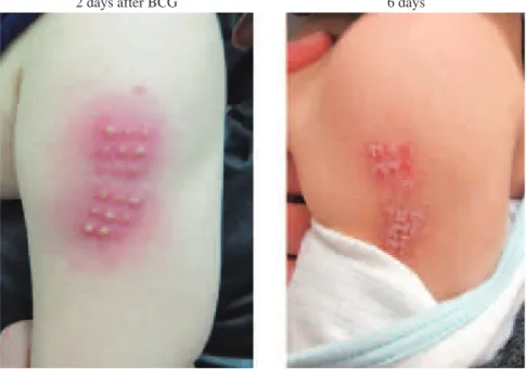 Fig. 1 BCG scars (on the left upper lateral arm of the case)
