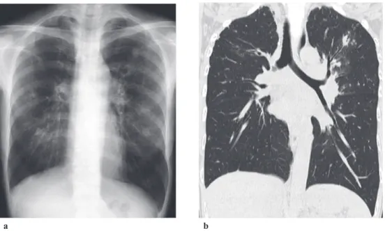 Fig. 1 a:  Chest  radiograph  image  at  the  time  of  diagnosis  of  pulmonary  tuberculosis  showed  multiple  spotty inﬁ ltrations in both lung ﬁ elds. b: Chest CT image at the time of diagnosis of pulmonary tuberculosis  showed multiple spotty inﬁ ltr