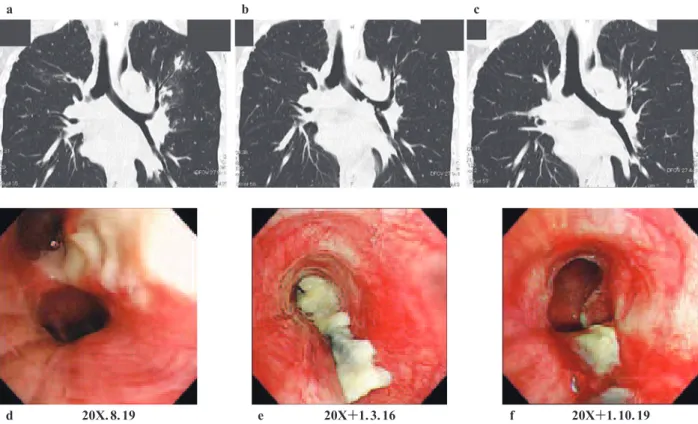 Fig. 2 a: CT image when pulmonary tuberculosis was diagnosed: no abnormal ﬁ ndings in the left main bronchus. b:  CT image 7 months after the beginning of anti-tuberculous therapy: tumorous shadows in the left main bronchus. c: CT  image 14 months after th
