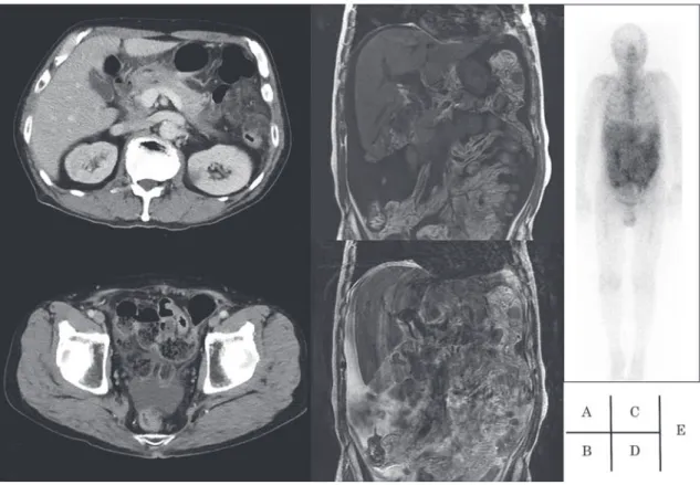 Fig. 1 (A) Abdominal CT scan showed stranding in the mesenteric fat. (B) A small amount of ascites were  stored in the Douglas  pouch. (C) Increased ascites were observed in the T1-weighted image. (D) High signal  intensity of mesentery were observed in th