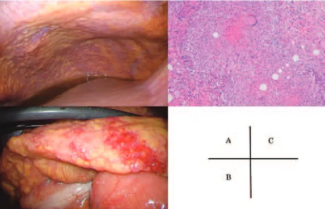 Fig. 3 (A)  A  large  number  of  miliary  white  nodules  spread  throughout  the  peritoneum.  (B)  The  greater  omentum were thickened (omental cake). (C) Histological ﬁ ndings of peritoneum revealed epithelioid cell  granulomas with caseous necrosis (