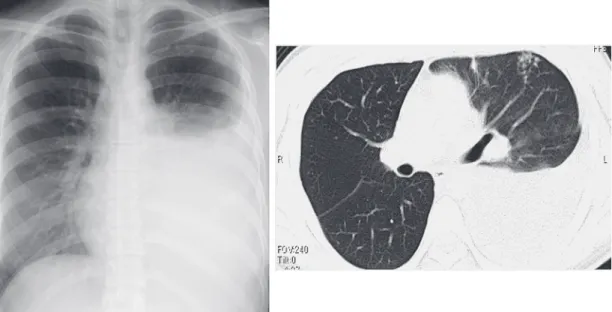 Fig. 1 (Case 1) Chest X-ray showed a large amount of pleural effusion in the left lung