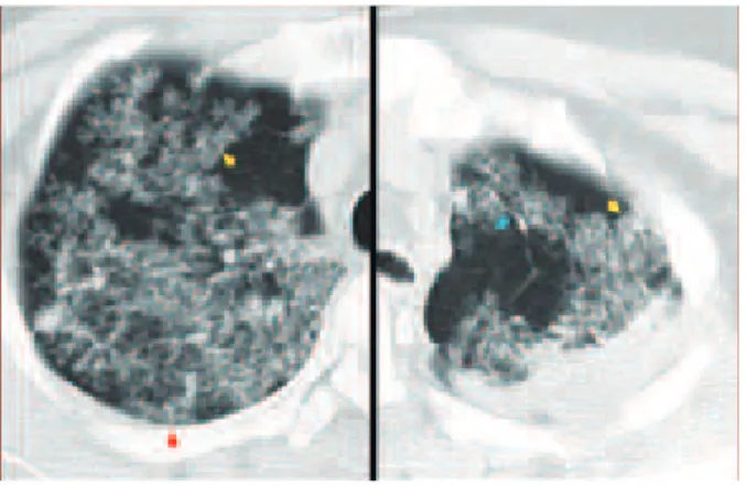 図 4  肺結核のHRCT 右肺に，多小葉性浸潤影と，高度に密集したtree-in-bud lesion が見られる。後者は細気管支から胸膜に達しているものが あり（赤矢印），一方で，小葉の端に到達しない病変も多く 見られる（青矢印）。病変幅はほぼ 1 mm であり，分岐して も太さがほとんど変わらない。密集した病巣の間に，わず かの隙間が見られる。この細い隙間は，侵されていない肺 胞道＋肺胞であり，病変をもつ同構造にコントラストを与 える。病変は小葉の広がりごとにまとまる傾向がある。 （国 立病院機構茨城
