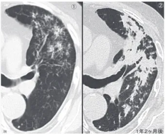 図 19 細葉中心性肺気腫の標本像 肺気腫の標本肉眼像は，画像教育上，細葉中心と細葉辺縁 を区別する訓練に最適である。ある程度進行した細葉中心 性肺気腫では，肉眼標本上，気腫域と残された正常部は明 瞭に区別できる。正常部は胸膜下のみならず，小葉・細葉 の境界域（細葉・小葉辺縁）にも残される。そのため，帯 状の正常肺（黄矢印）が多角形様に気腫域を囲むような特 異な像を呈する。残された気管支と肺実質が，肺結核の発 症と進展の場となる。図 18 肺結核におけるHRCT経過（3）抗結核剤による治療経過を示す（左図は