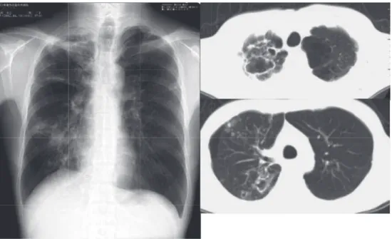 図 線維空洞型肺MAC 症（40代男性，喫煙者） 右上葉に薄壁空洞を複数認める。左側上葉には喫煙による嚢胞が複数存在する。 診断時より空洞があり，嚢胞感染から空洞が生じたと推測される例である。562結核  第93 巻  第11 _ 12 号  2018年 11 _ 12月 に反比例していたと報告されています。米国では BCG を打っていないので，ツベルクリン反応陽性者は感染者 ですので，つまり，やせていると発病しやすいという結 論になります。一方，NB 型肺 MAC症患者はやせ型（も ともと身長が高い）の女