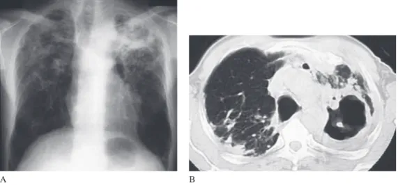 Fig. 10 Mycobacterium intracellulare  pulmonary  disease  associated  with  pneumoconiosis  (example  case of ﬁ brocavitary disease) 9) Chest X-ray (A) shows large cavities in both upper lung ﬁ elds and upper lung ﬁ eld predominance. Chest  computed tomogr