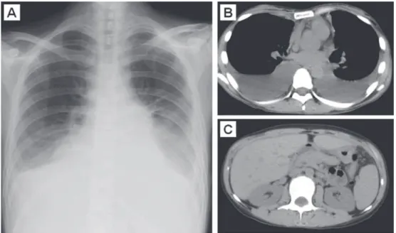 Fig. 1 Chest X-ray and chest and abdominal CT on initial admission A) Chest X-ray revealed radiolucency in bilateral lower lung ﬁ elds, bilateral dull costophrenic angles  and an enlargement of cardiac silhouette. B) Chest CT scan showed bilateral pleural 
