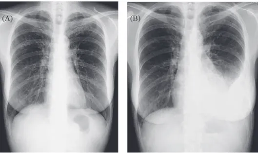 Fig. 1 (A) Chest X-ray on initial visit shows diffuse nodular shadow.  (B) After 2 months  of antituberculous therapy administration, chest X-ray revealed left pleural effusion