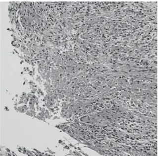 Fig. 4 Histological  ﬁ ndings  of  subphrenic  abscess  revealed epithelioid cell granulomas with necrosis and  Langhans giant cells