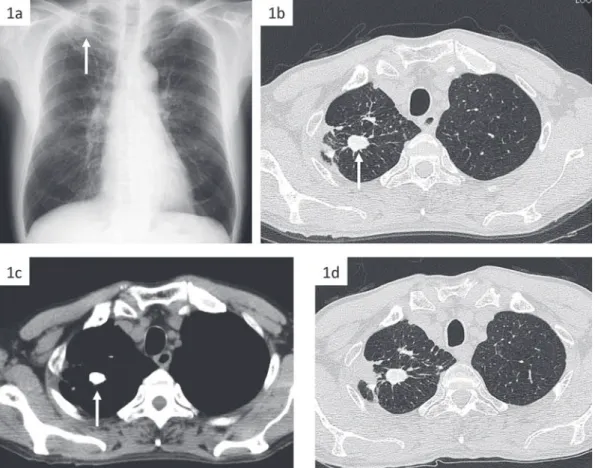 Fig. 1 A lung nodule was detected in the right upper lobe using chest X-ray (1a) and computed  tomography  (CT)  (1b  [lung  ﬁ eld  view],  c  [mediastinal  view]).  After  3  months,  the  panacinar  segmental consolidations have appeared (1d).  Fig