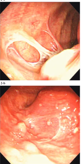 Fig. 2 Thoracoscopy revealed white fibrinous membranes  (2-a)  and  multiple  nodules  (2-b)  on  the  surface  of  the  visceral pleura.