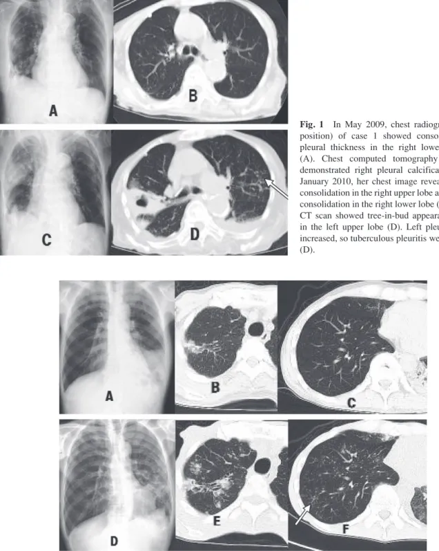 Fig. 1 In  May  2009,  chest  radiograph  (supine  position)  of  case  1  showed  consolidation  and  pleural  thickness  in  the  right  lower  lung  field  (A).  Chest  computed  tomography  (CT)  scan  demonstrated  right  pleural  calcification  (B). 