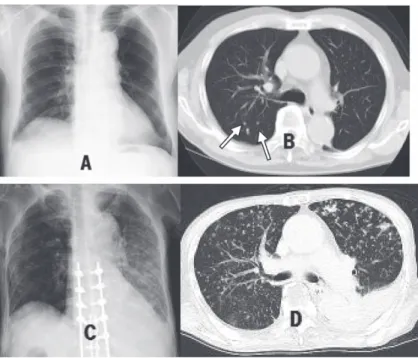 Fig. 3 In July 2009, chest radiograph of case 3  showed several small nodules in the right middle   and lower lung field (A). Chest computed tomog-raphy  (CT)  scan  demonstrated  micronodules  (arrows) of 2 ̲ 3mm in size, some of which were  calcified  (B