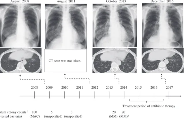 Fig. In 2008, thickening of bronchial walls and small nodules with bronchiectasia were observed in bilateral lungs. She  was diagnosed with pulmonary MAC infection. She had no symptoms for some years. But on October 2013 wet cough  appeared and worsening o