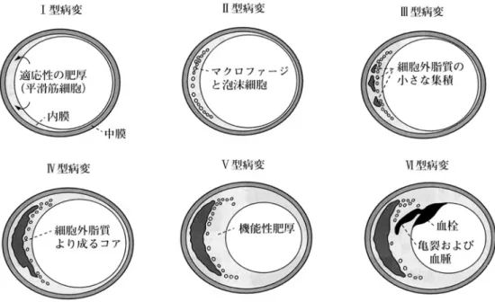 図 1 動脈硬化の分類（（文献 2）より St ar y分類を改変） 脈硬化とは関係が薄く，脳底動脈のウイリス動脈輪 に好発し，クモ膜下出血の原因となる．動脈解離は 上行大動脈に裂孔が形成される．中膜の囊胞状壊死 が原因とされ，collagen の先天的異常であるマル ファン症候群で好発する．原発性血管炎は，侵襲を 受ける血管の種類により分類されるが，大動脈と第 1 分枝を侵す巨細胞性動脈炎（側頭動脈炎），高安動 脈炎，中動脈の血管炎である結節性多発動脈炎，川 崎病，細動脈，毛細血管，細静脈の血管炎である 