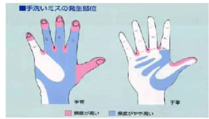 図  手洗いミスの発生箇所  【手あれ防止】  一日に何度も手洗い・消毒を行うことで手荒れを招いてしまうこともあります。 手荒れを防ぐことは感染予防としても重要なことです。手洗い・消毒後にはハンド クリームなどを使用して、油分を補給して手荒れを防ぎます。また、壷型タイプよ り雑菌の入りにくいチューブ型かポンプ型を使用すること。またひどいときは手袋 を着用してください。手荒れでカサカサになった手は病原ブドウ球菌などがつきや すくなります。洗剤の使い過ぎを避け．ゴム手袋などを使用するようにします。  6-3 手
