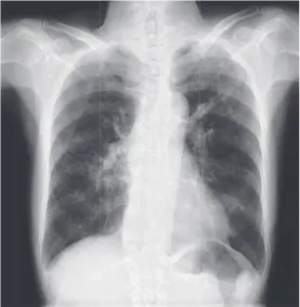 Fig. 1 Chest X-ray showed inﬁ ltration in the right middle  lung ﬁ eld and nodule in the left upper lung ﬁ eld